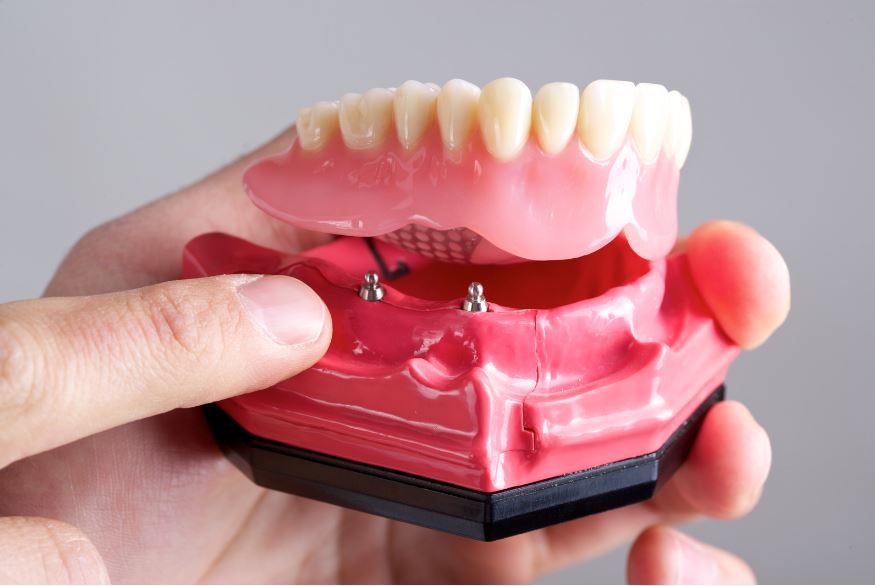 Imagen de una dentadura o protesis dental a presión. Sobre implantes dentales