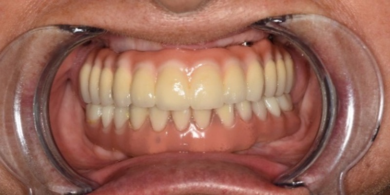 Implantes subperiósticos. Dentadura fija atornillada